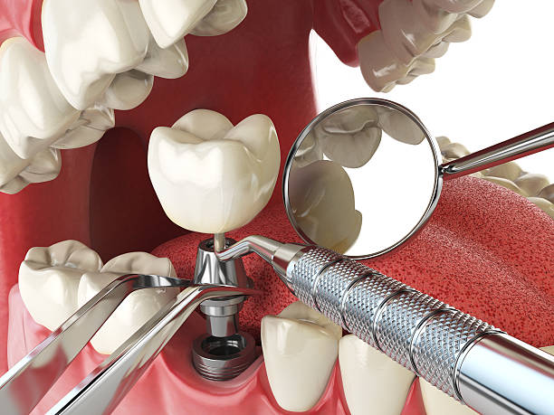 Best Emergency Root Canal Therapy in Todd Creek, CO
